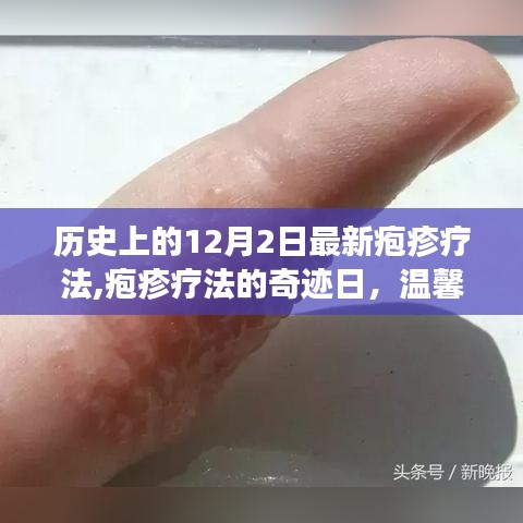 皰疹療法的奇跡日，友情與愛在歷史上的溫馨故事