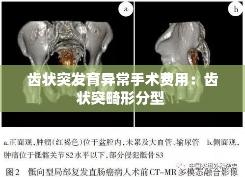 齒狀突發育異常手術費用：齒狀突畸形分型 