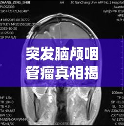 突發腦顱咽管瘤真相揭秘，探究疾病背后的秘密